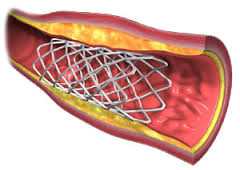 What stents look like internally.